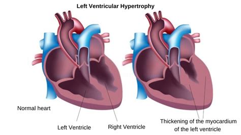 lv enlargement|left ventricular enlargement symptoms.